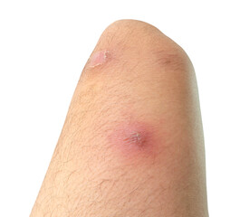 abscess or skin disease on human thigh isolated with clipping path in png file format