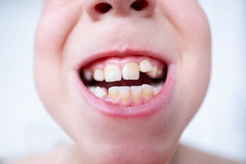 close-up teeth of child, boy 10 years old new tooth fang in mouth with finger, concept children's...