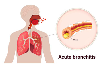 Acute bronchitis. Lung diseases. Caused by a viral infection. Human respiratory system.