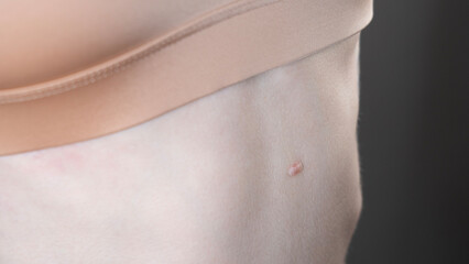 a woman's belly with a small round scar left after mole removal, close up, skin conditions, dermatology, treatment