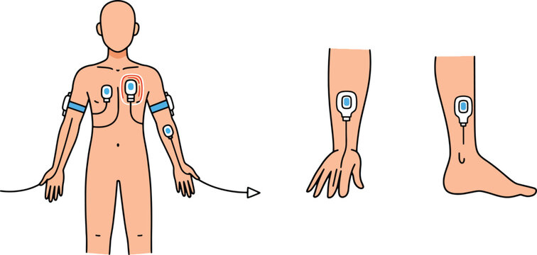 Electrocardiogram (ECG) Lead Placement A Comprehensive Guide to Electrode Positioning on the Body
