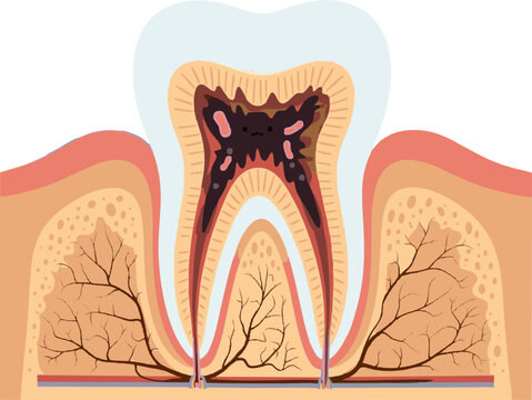 Cartoon tooth cross-section with a large cavity and exposed root canals