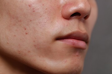 Fototapeta premium Cheek acne and facial blemishes, shown in realistic detail with visible pores and inflammation, taken indoors, suitable for medical education, skin health articles, or cosmetic brand visuals.