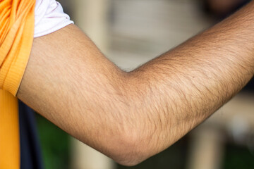A fair-skinned boy shows his elbow