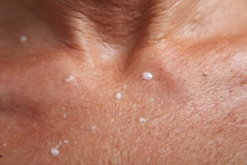 Fototapeta premium Human skin with visible clogged pores, displaying tight texture and raised white spots in a clinical close-up, photographed indoors, perfect for dermatological articles or product comparisons.