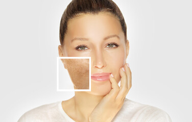 Dark spots, freckles,hyperpigmentation(melasma or chloasma),concept- skin lightening, skin whitening, Skin Brightening