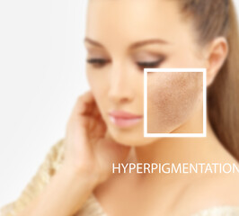 Dark spots, freckles,hyperpigmentation(melasma or chloasma),concept- skin lightening, skin whitening, Skin Brightening