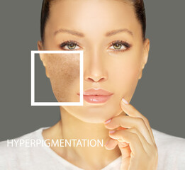 Dark spots, freckles,hyperpigmentation(melasma or chloasma),concept- skin lightening, skin whitening, Skin Brightening