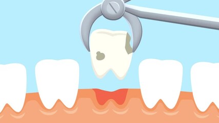 Dental extraction procedure illustrating a tooth being removed with a dental tool against a clean background