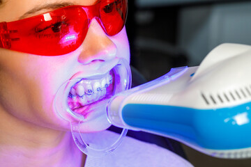 Dental whitening procedure with blue light on patient wearing red protective glasses