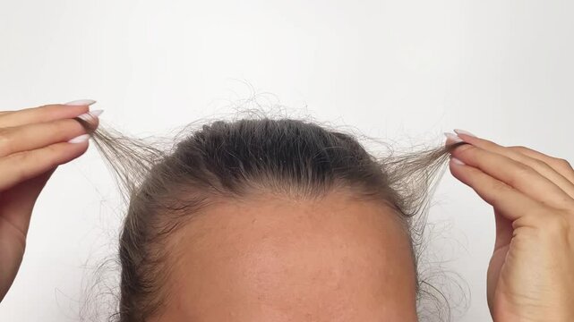 Young woman showing bald spots on forehead and temples with fingers. Baldness. Close-up. Hair care concept and treatment. Hair loss, hair transplant, alopecia