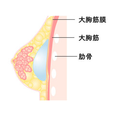 バッグ豊胸_乳腺下法