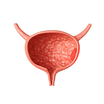 Urinary bladder isolated on white background. Urinary bladder cancer illness concept