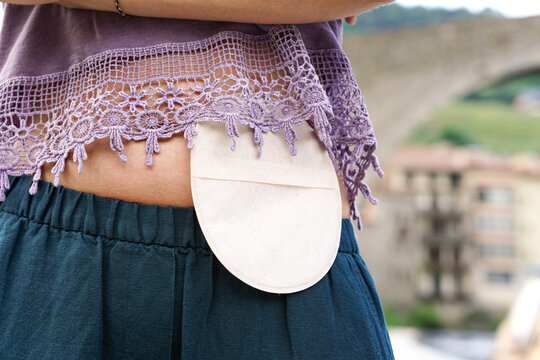 close up of an ostomy bag in a medieval village. World Cancer Day
