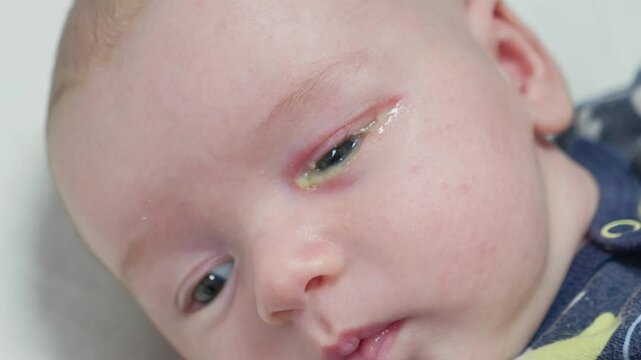 Baby eyes with eye mucus in selective focus. Disease tear ducts tons of newborns close up. Nasolacrimal duct obstruction in baby it is a blockage of the lacrimal drainage system. 