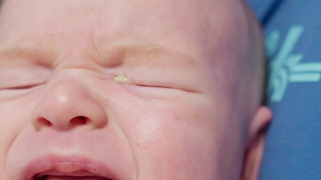 Baby eyes with eye mucus in selective focus. Disease tear ducts tons of newborns close up. Nasolacrimal duct obstruction in baby it is a blockage of the lacrimal drainage system. 