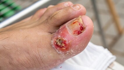 Severe Foot Ulcers and Infections Causes and Treatments
