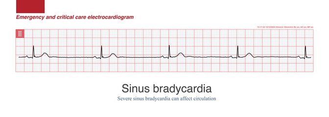 Female, 71 years old, clinically diagnosed with coronary heart disease. The electrocardiogram shows severe sinus bradycardia, with symptoms of dizziness and a blood pressure of 80 and 40mmHg.
