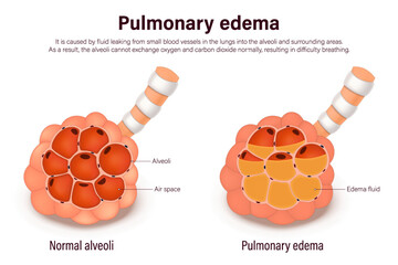 Pulmonary edema. Comparison between normal alveoli and pulmonary edema. Lung diseases anatomy. Human respiratory system.