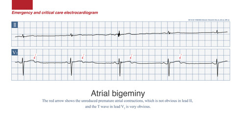 When atrial bigeminy is not transmitted to the ventricle, it will form a special bradyarrhythmia, which is easy to be misdiagnosed as sinus bradycardia or 2:1 sinoatrial block.
