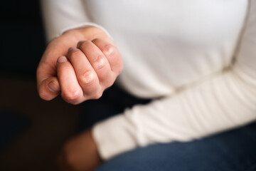 Woman with scar on her knuckles about a year after injury, female showing an old visible scars, skin texture and recovery, close-up