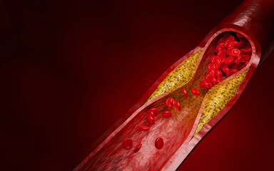 Artery clogged by unhealthy junk food, sugary drinks, and alcohol, illustrating serious cardiovascular risks, atherosclerosis, and heart disease problems in human blood vessels. 3D rendering.