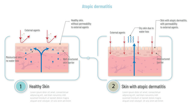 Healthy skin compared to skin with atopic dermatitis showing permeability to external agents