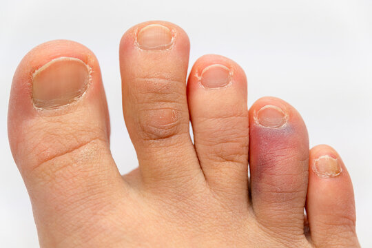 Bruised big toe on caucasian adult foot with swelling and discoloration