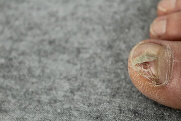 nail diseases. Destroyed nail plate, fungal diseases of the feet. Podology