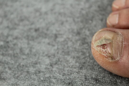 nail diseases. Destroyed nail plate, fungal diseases of the feet. Podology