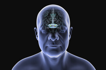 Human brain with degenerated substantia nigra in Parkinson's disease, showing loss of pigmented neurons in the midbrain related to motor dysfunction, 3D illustration.