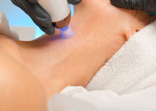 Close-up portrait of a beautiful aged woman during microneedling with dermapen from a beautician.