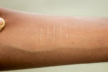 A young man shows his hand and has numerous scars on it.