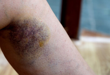 Bruises in the leg area after a minor fall, a visible discoloration and swelling indicate soft...