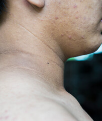Black stains on the skin around the neck