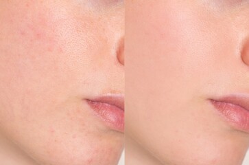 Side-by-side macro image shows visible reduction of pores, redness and blemishes on a woman’s...