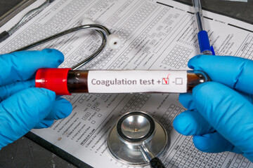 Doctor holding positive coagulation test tube in laboratory