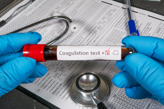 Doctor holding positive coagulation test tube in laboratory - Powered by Adobe