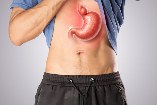 A Hiatal Hernia is illustrated with a line drawing showing the body&rsquo;s internal symptom part of the stomach pushing through the diaphragm into the chest cavity. Stomachache. 
