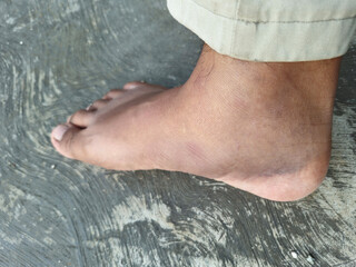 Bad bruise foot and leg of the man has swollen foot. Accident, sprain ankle, Ankle injury. First...