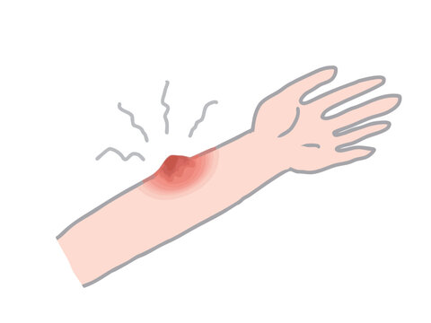 Illustration of a swollen arm caused by an insect bite