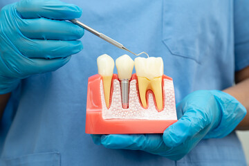 Dental implant, artificial tooth roots into jaw, root canal of dental treatment, gum disease, teeth...