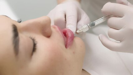Injection procedure for lip augmentation, close-up. The cosmetologist slowly and carefully injects filler into the client’s lips. Advertising concept for facial care, youth and beauty. - Powered by Adobe