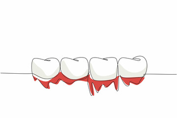Single one line drawing 4 teeth in a row with bleeding gums. Due to vitamin C deficiency. Inflammation of the gums. International Scurvy Awareness Day. Continuous line design graphic illustration