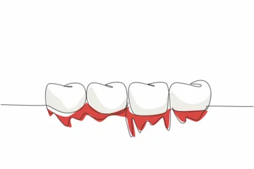 Fotobehang Single one line drawing 4 teeth in a row with bleeding gums. Due to vitamin C deficiency. Inflammation of the gums. International Scurvy Awareness Day. Continuous line design graphic illustration © Simple Line