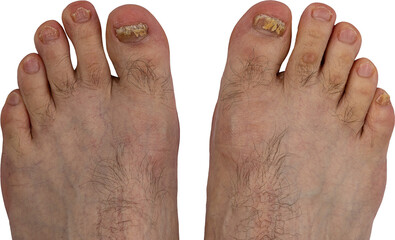 Feet of a man close-up of fingers affected by a fungal nail plate. Ugly toes.