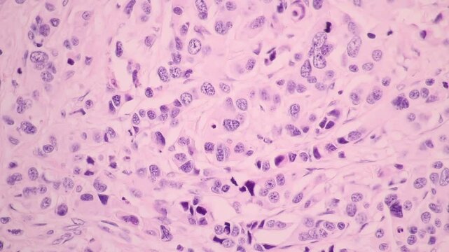 View in microscopic of glandular epithelial cell, adenonocarcinoma from human lung cancer, tissue section by H and E stain.Pathology diagnosis.Medical concept. Under microscope, magnification 600X