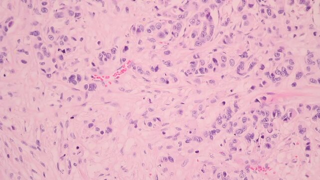 View in microscopic of glandular epithelial cell, adenonocarcinoma from human lung cancer, tissue section by H and E stain.Pathology diagnosis.Medical concept. Under microscope, magnification 600X