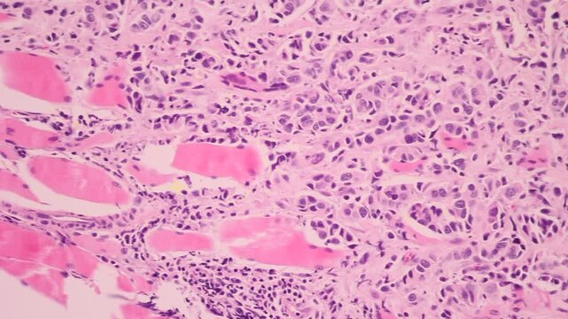 View in microscopic of glandular epithelial cell, adenonocarcinoma from human lung cancer, tissue section by H and E stain.Pathology diagnosis.Medical concept. Under microscope, magnification 600X