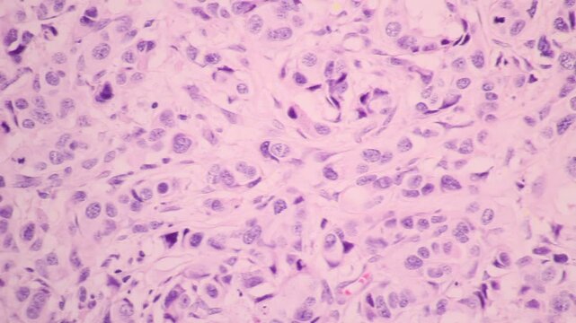 View in microscopic of glandular epithelial cell, adenonocarcinoma from human lung cancer, tissue section by H and E stain.Pathology diagnosis.Medical concept. Under microscope, magnification 600X